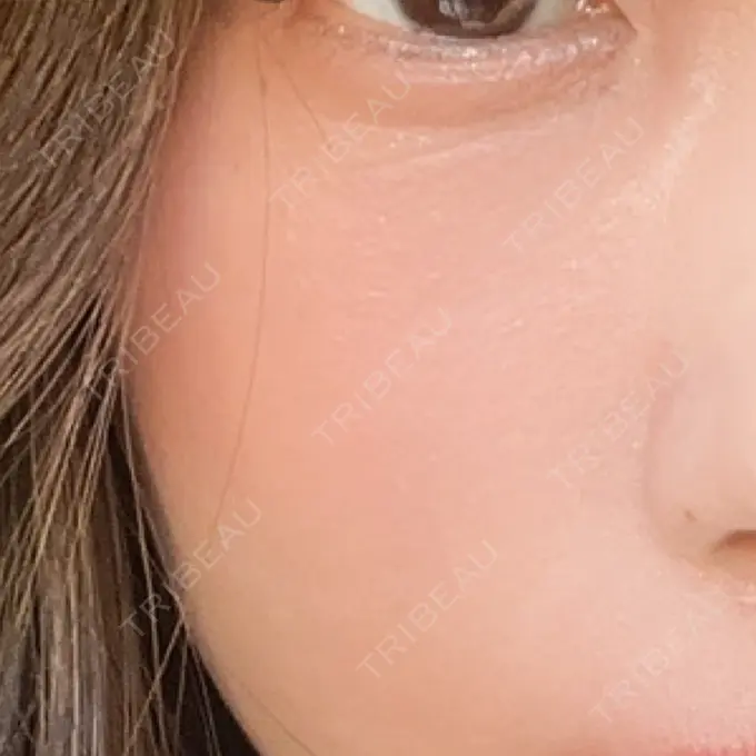 水光注射（ハリ・美肌） 筋肉・美容クリニック BEFORE メイン用