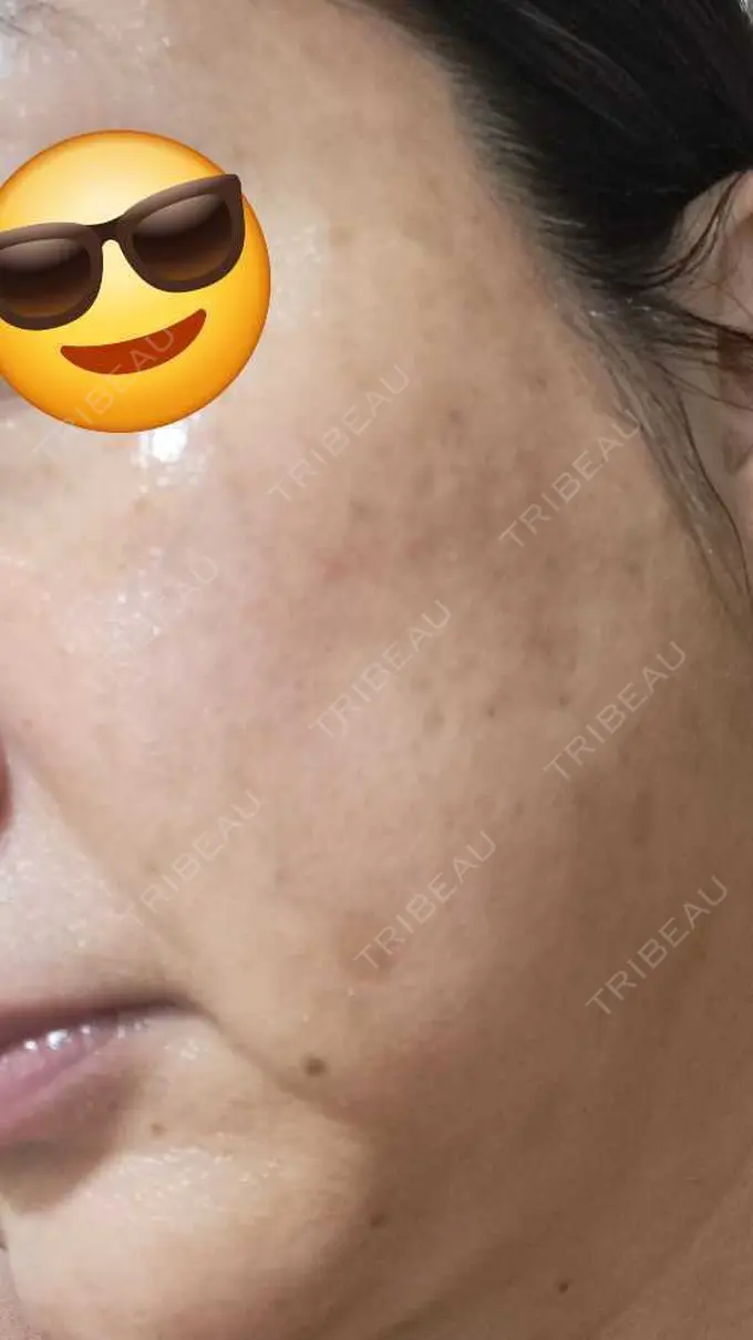 水光注射（ハリ・美肌） しんゆり美容健康クリニック BEFORE メイン用