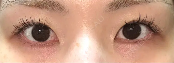 二重埋没 / 目頭切開 / その他（目元） eクリニック 福岡院 BEFORE メイン用