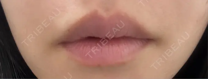 ヒアルロン酸注入（唇） オラクル美容皮膚科 福岡天神院 BEFORE メイン用