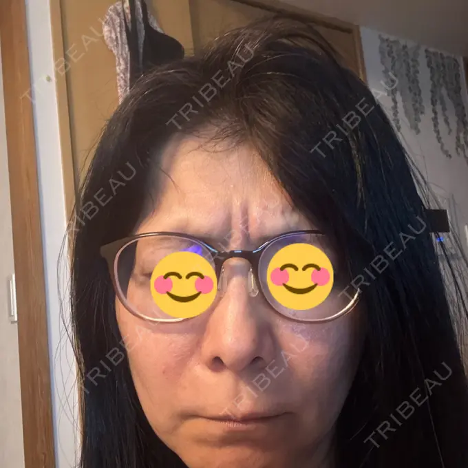 肌育注射（ジュベルックなど） Natural Skin Clinic 自由ヶ丘院 BEFORE メイン用