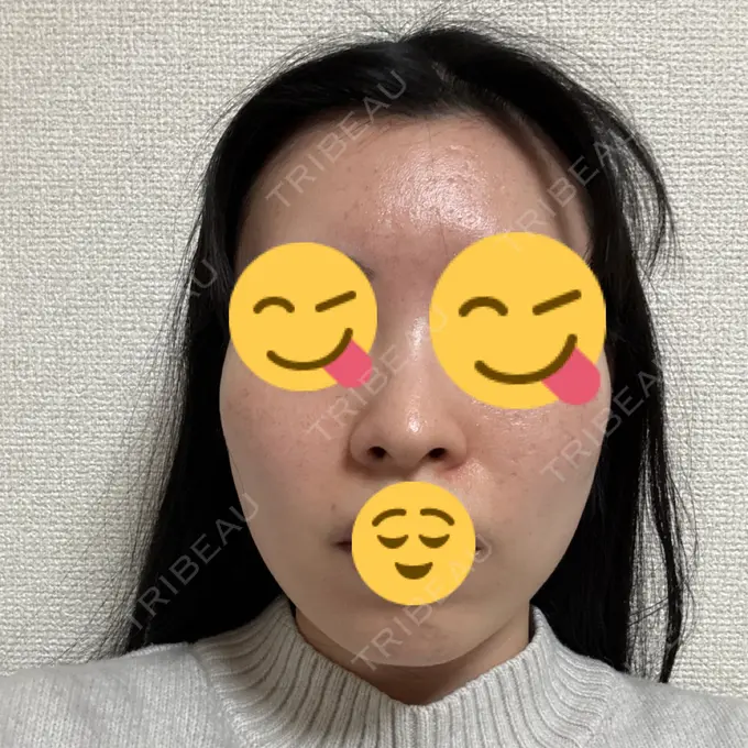 ニードルRF（ポテンツァなど） KM新宿クリニック BEFORE メイン用