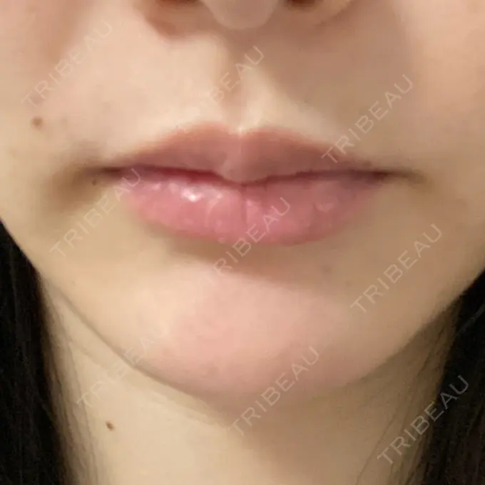 人中短縮 / 口角挙上 R Beauty CLINIC 銀座院 BEFORE メイン用