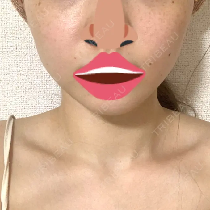 ボトックス（エラ・小顔） 品川スキンクリニック心斎橋院 BEFORE メイン用