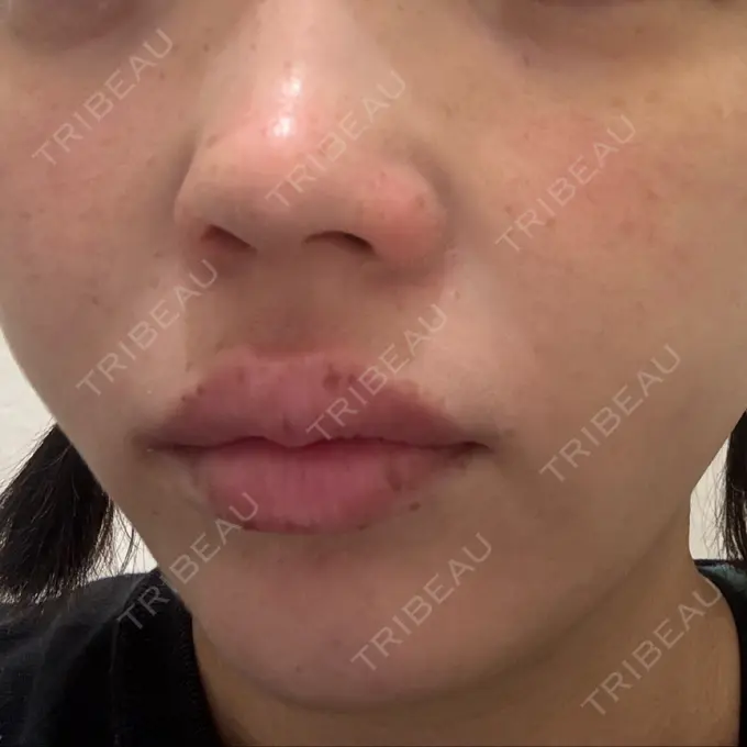 ピコレーザートーニング（美白・肝斑） ルラ美容クリニック 広島院 BEFORE メイン用