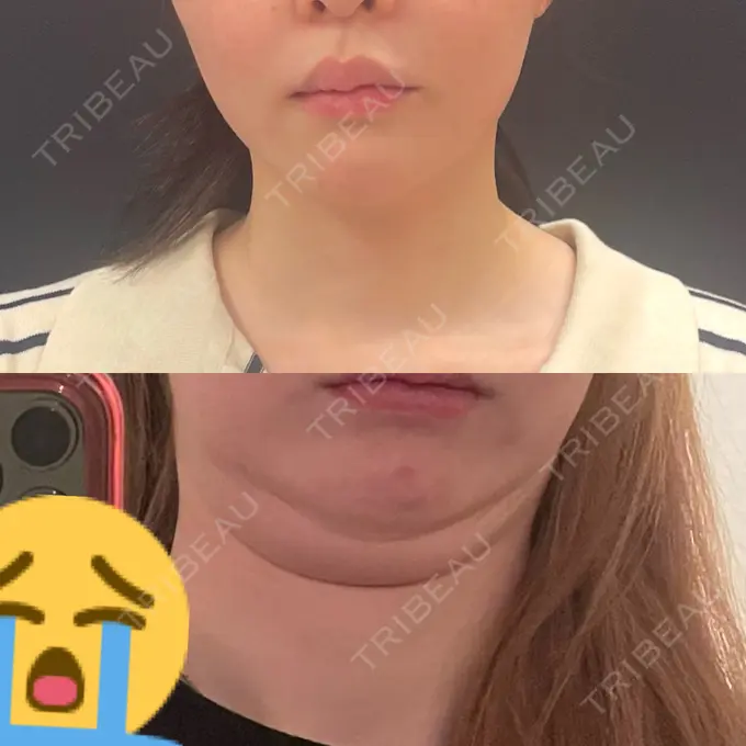 糸リフト / 脂肪吸引（顔） ヴェルトラクリニック 新宿院 BEFORE メイン用