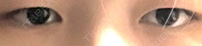 二重埋没 高須クリニック 名古屋院 BEFORE メイン用