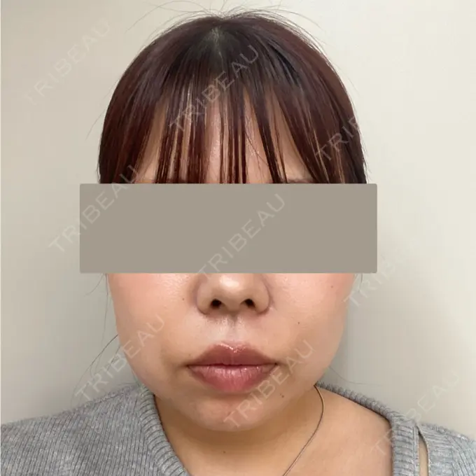 脂肪吸引注射（顔） / ボトックス（あご） / ボトックス（口角） / ボトックス（眉間） / その他（口元） TCB東京中央美容外科 静岡院 BEFORE メイン用
