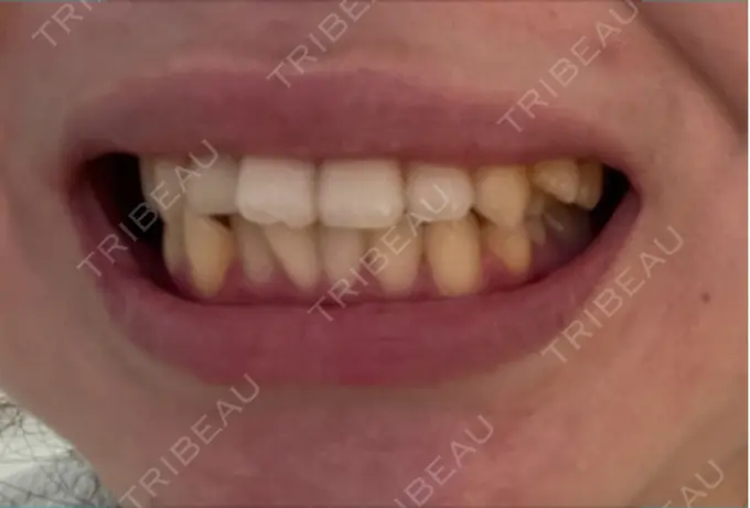 ホワイトニング / その他（審美歯科/矯正歯科） 宇田川歯科医院 BEFORE メイン用