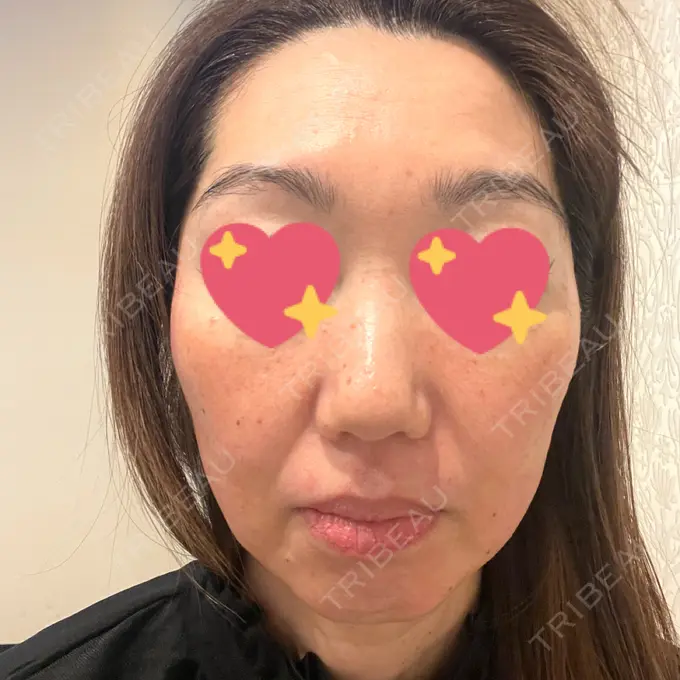 ピーリング（ハリ・ツヤ） / ルメッカ 大美会クリニック 梅田院 BEFORE メイン用