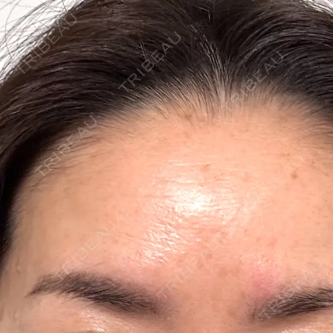 ボトックス（額） veary clinic BEFORE メイン用