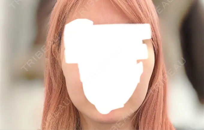 RF（高周波）たるみ治療 MKクリニック 日本橋院 BEFORE メイン用