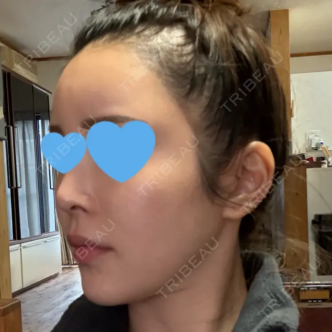 ハイフ（顔） / ミラノリピール 表参道メディカルクリニック 福岡天神院 BEFORE メイン用