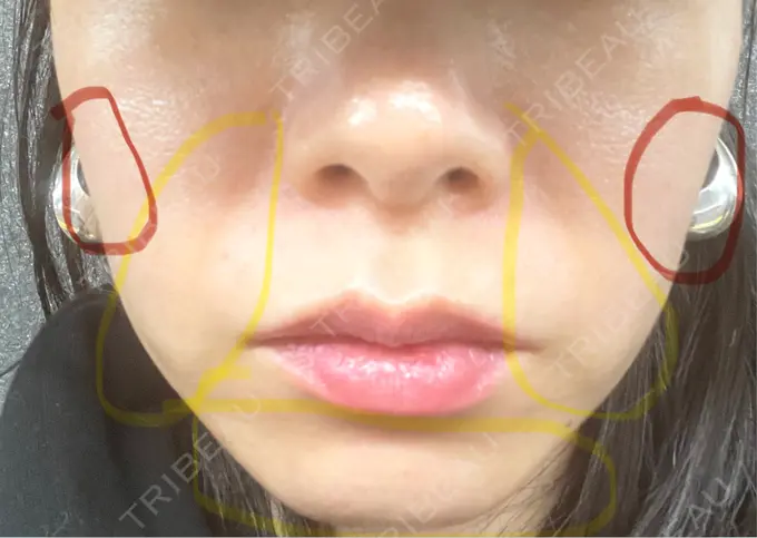 その他（輪郭） ライブリークリニック 浜松町院 BEFORE メイン用