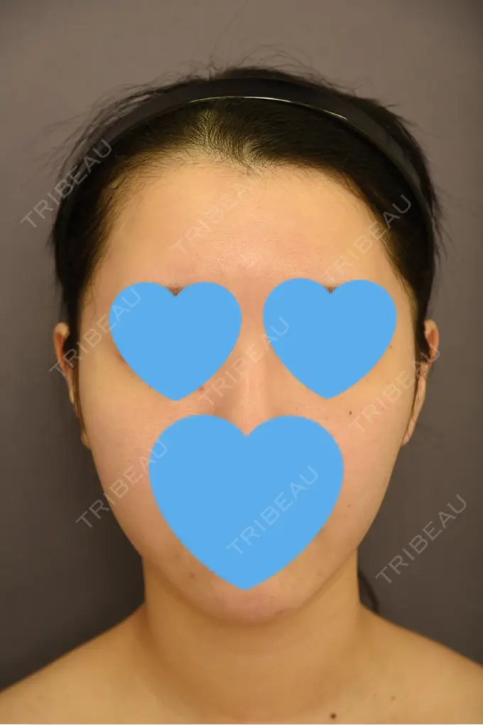 骨切り（あご） / 脂肪吸引（二の腕） 札幌ル・トロワ ビューティクリニックVogue BEFORE メイン用