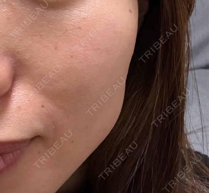 ダーマペン 新宿美容外科クリニック 立川院 BEFORE メイン用