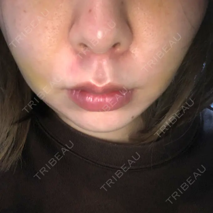 糸リフト / その他（輪郭） PRISM Beauty Clinic 町田院 BEFORE メイン用