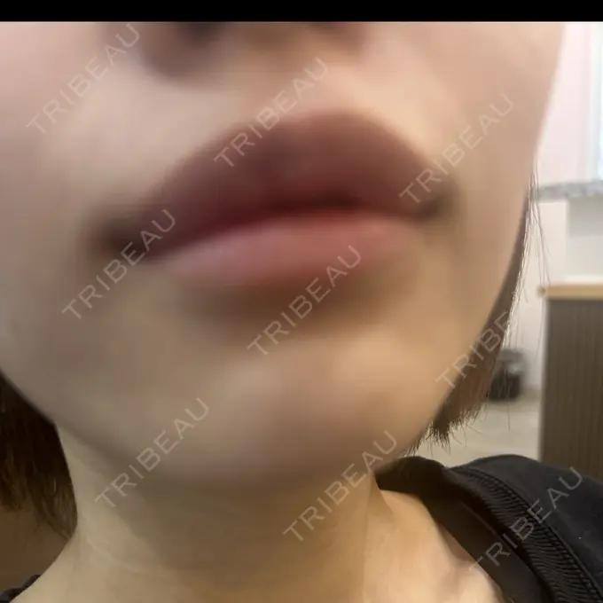 ヒアルロン酸注入（唇） アネシス美容クリニック BEFORE メイン用