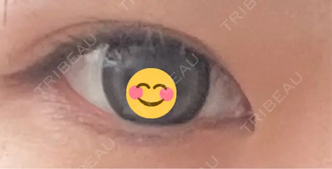 ヒアルロン酸注入（涙袋） LIBER CLINIC BEFORE メイン用