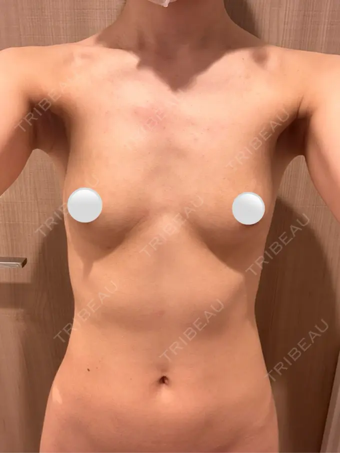 脂肪吸引（お腹） / 豊胸（脂肪注入） / 脂肪吸引（背中） ルーチェクリニック 銀座院 BEFORE メイン用