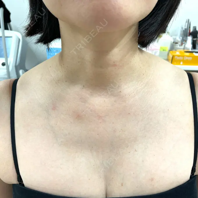 ベビーコラーゲン / シミ取りレーザー / ほくろ・いぼ除去レーザー（首） 渋谷美容外科クリニック 渋谷院 BEFORE メイン用