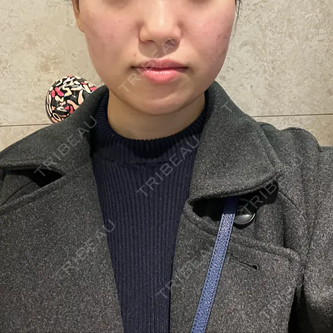 脂肪溶解注射（顔） / その他（輪郭） ドクタープチ美容クリニック -江南店 BEFORE メイン用