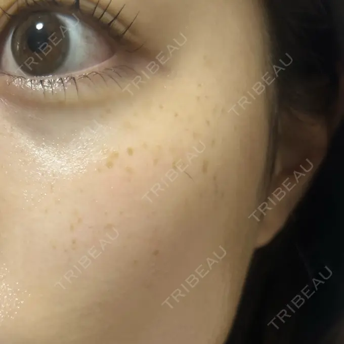 イオン導入 / ルメッカ ルラ美容クリニック 池袋院 BEFORE メイン用