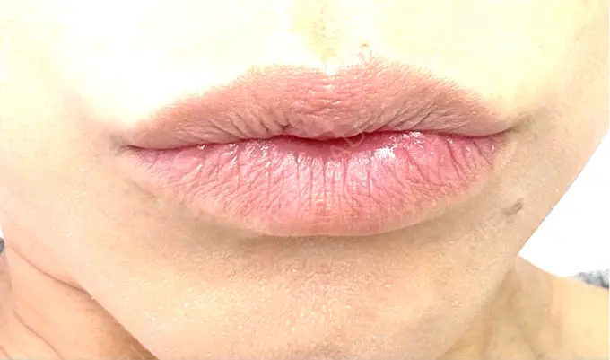 ボトックス（あご） / ヒアルロン酸注入（唇） / ボトックス（口角） / その他（口元） ルラ美容クリニック 神戸院 BEFORE メイン用