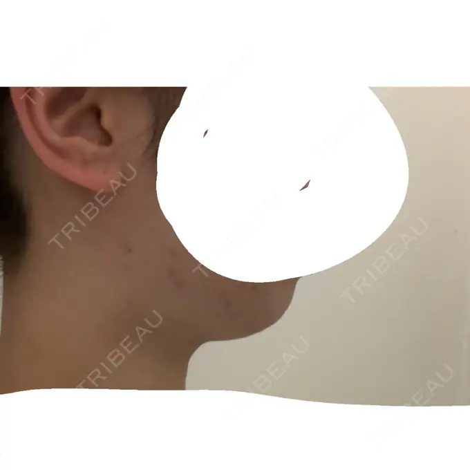 RF（高周波）たるみ治療 大美会クリニック 天王寺院 BEFORE メイン用