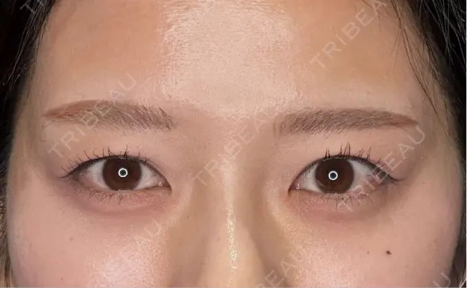 二重切開 / 眼瞼下垂（切開） eクリニック 新宿院 BEFORE メイン用