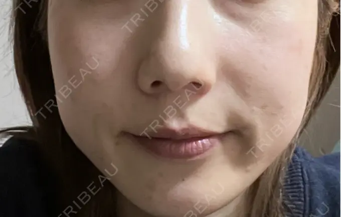 水光注射（ハリ・美肌） / ダーマペン KM新宿クリニック BEFORE メイン用