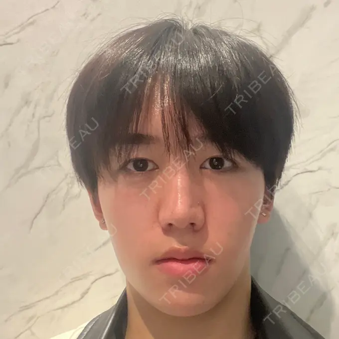 ボトックス（エラ・小顔） eクリニック 東京院 BEFORE メイン用