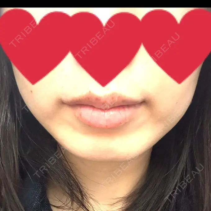 ボトックス（エラ・小顔） 共立美容外科 名古屋院 BEFORE メイン用