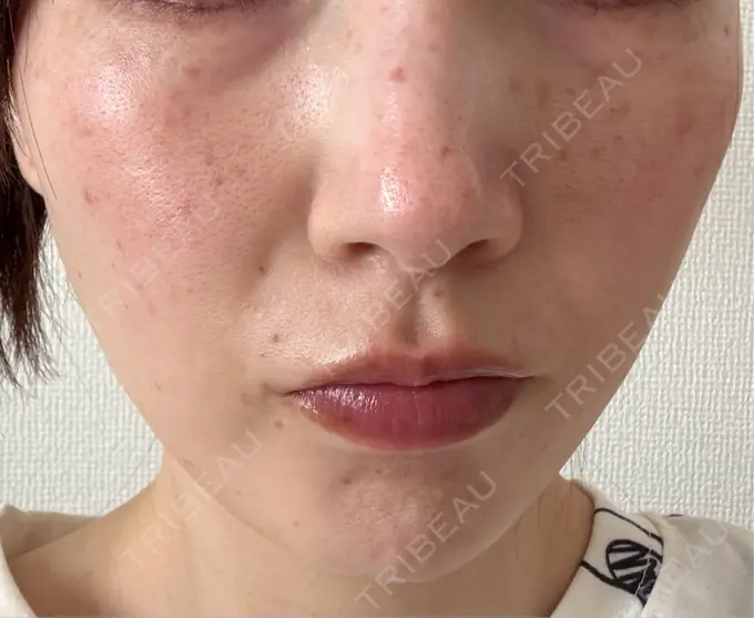 シミ取りレーザー / ピコスポット アモーレクリニック 名古屋院 BEFORE メイン用