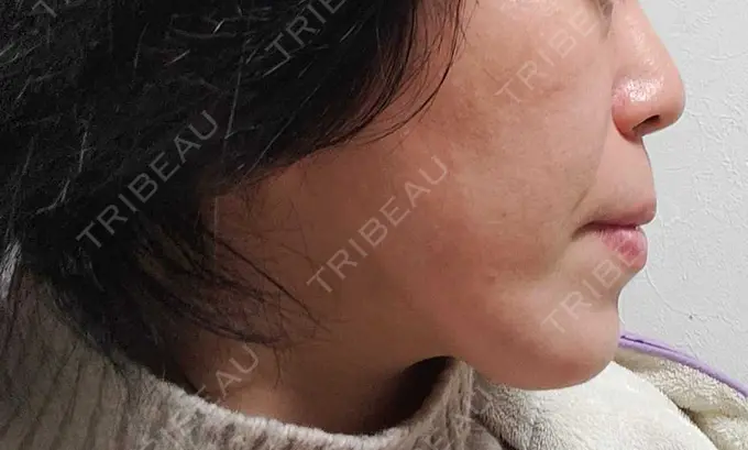 RF（高周波）たるみ治療 表参道メディカルクリニック 表参道院 BEFORE メイン用