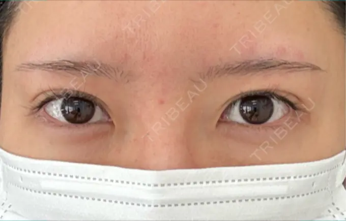 目頭切開 / クマ治療 / 目尻切開 / タレ目形成・グラマラスライン（切開） eクリニック 福岡院 BEFORE メイン用