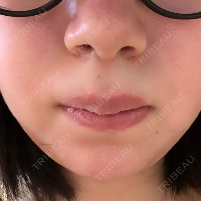 毛穴洗浄（ハイドラフェイシャルなど） / レーザートーニング（美白・肝斑） 表参道ウィズ・クリニック BEFORE メイン用