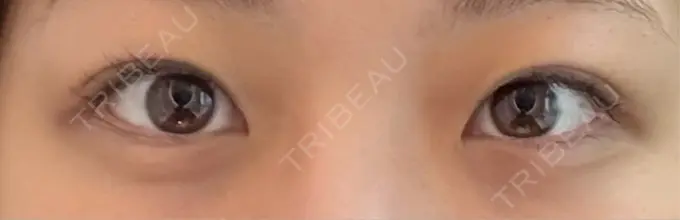 二重埋没 / 目元修正 水の森美容クリニック 東京渋谷院 BEFORE メイン用