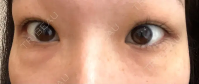 クマ治療 BELLMONA CLINIC BEFORE メイン用