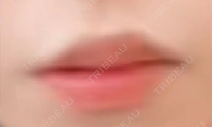 ヒアルロン酸注入（涙袋） / ヒアルロン酸注入（唇） アネシス美容クリニック BEFORE メイン用