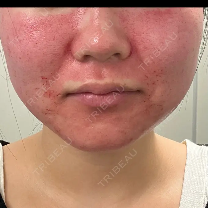 ピコレーザートーニング（美白・肝斑） / ピコフラクショナルレーザー（毛穴・ニキビ跡） 東京シルククリニック 新宿院 BEFORE メイン用