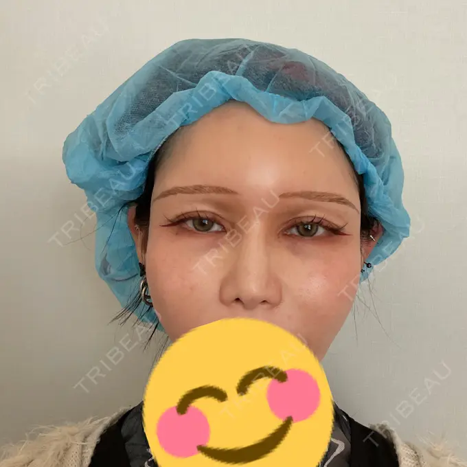 小鼻縮小（非切開） 形成外科と美容外科のクリニック池袋 BEFORE メイン用