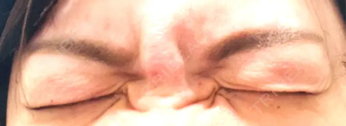 ボトックス（眉間） / ボトックス（額） / その他（肌） TCB東京中央美容外科 新横浜院 BEFORE メイン用