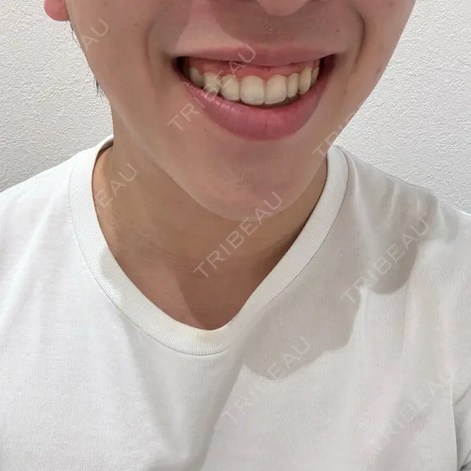 ボトックス（あご） / ボトックス（ガミースマイル） eクリニック 福岡院 BEFORE メイン用