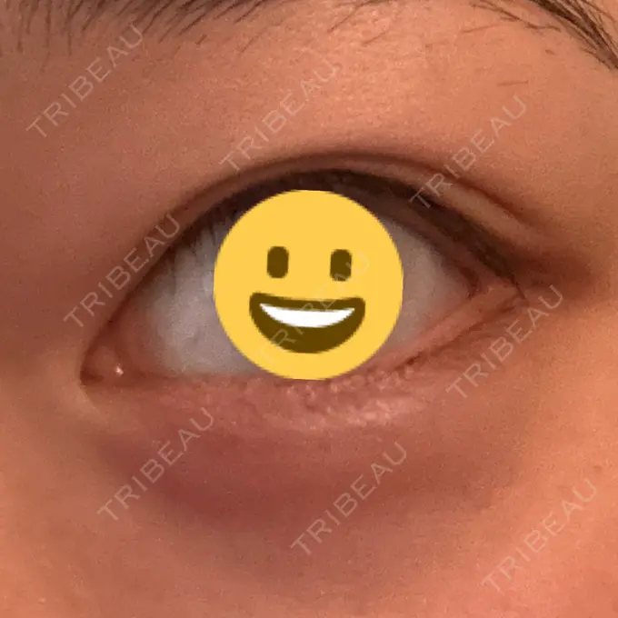 ヒアルロン酸注入（涙袋） フィラークリニック 町田院 BEFORE メイン用