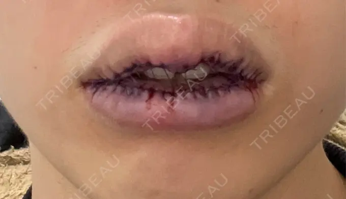 口唇縮小術 高須クリニック 大阪院 BEFORE メイン用