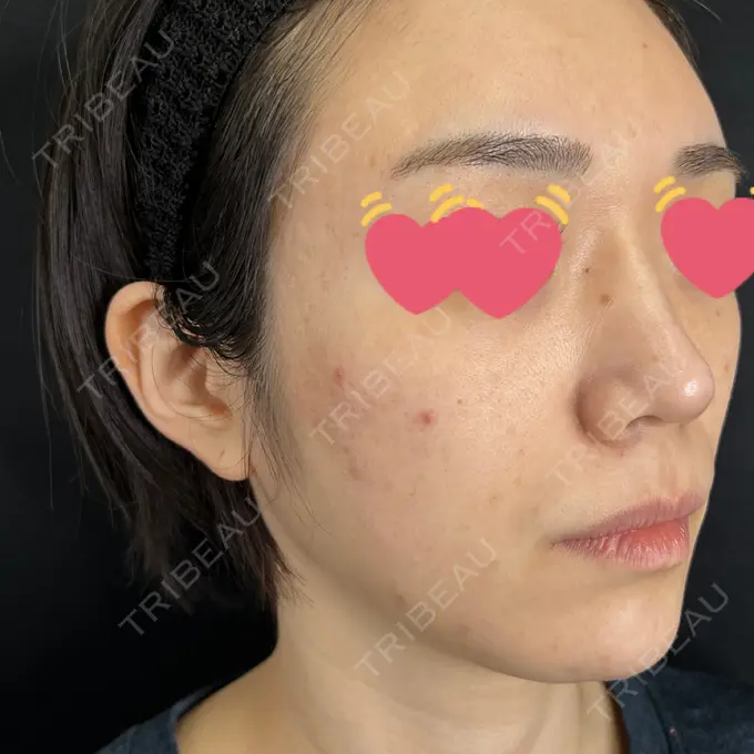 サブシジョン 藤・ナチュレ美容クリニック 銀座院 BEFORE メイン用