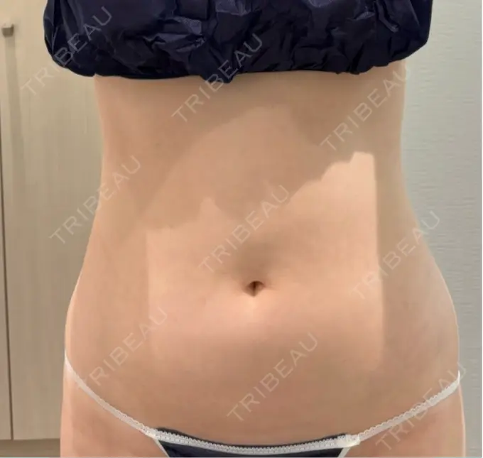 脂肪吸引（お腹） / 脂肪吸引（腰） Mods Clinic（モッズクリニック） 大阪院 BEFORE メイン用