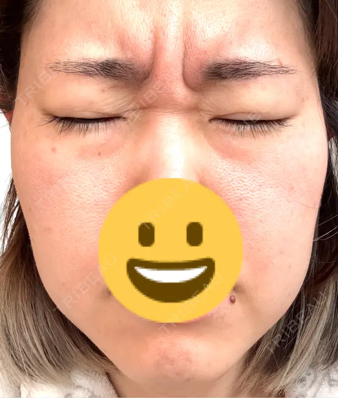 ボトックス（エラ・小顔） / シワ取りボトックス / ボトックス（眉間） ルラ美容クリニック 岡山院 BEFORE メイン用