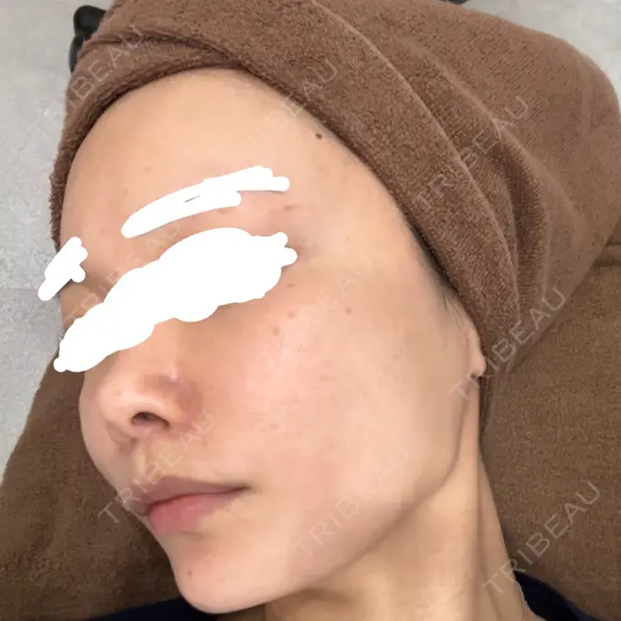 肌育注射（ジュベルックなど） / その他（肌） ゆきスキンクリニック 東池袋 BEFORE メイン用